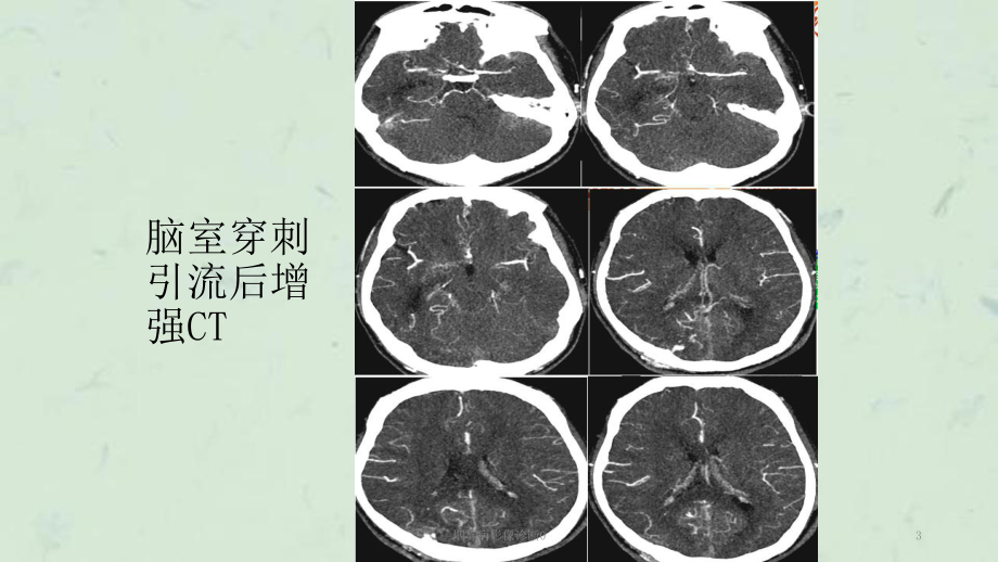 烟雾病影像诊断0课件.ppt_第3页