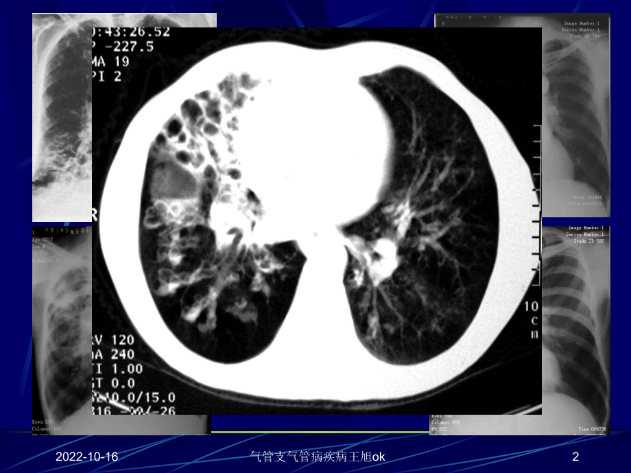 气管支气管病疾病课件.ppt_第2页