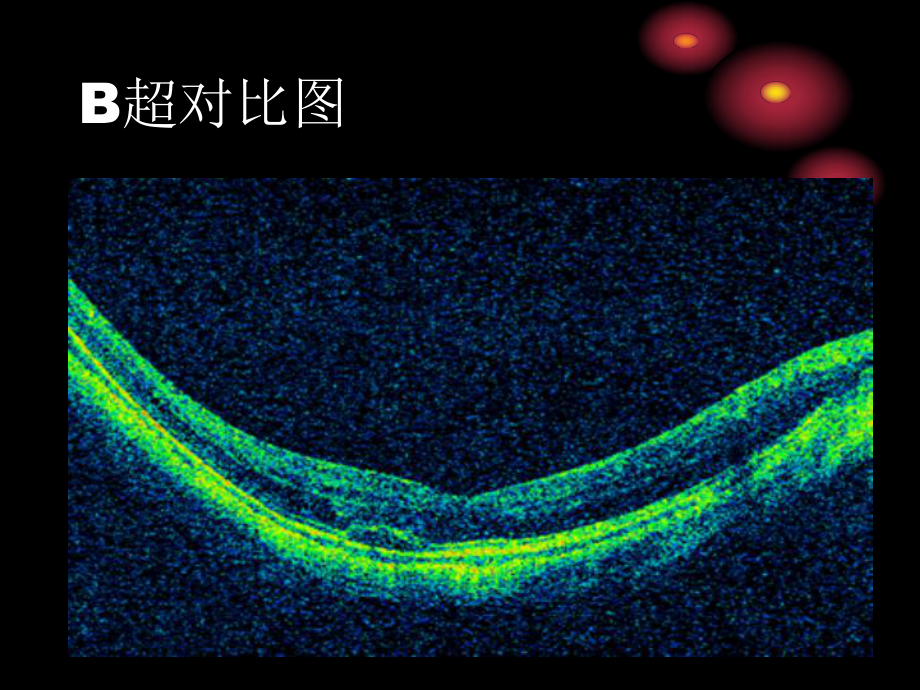 OCT的应用及检查1.ppt_第3页