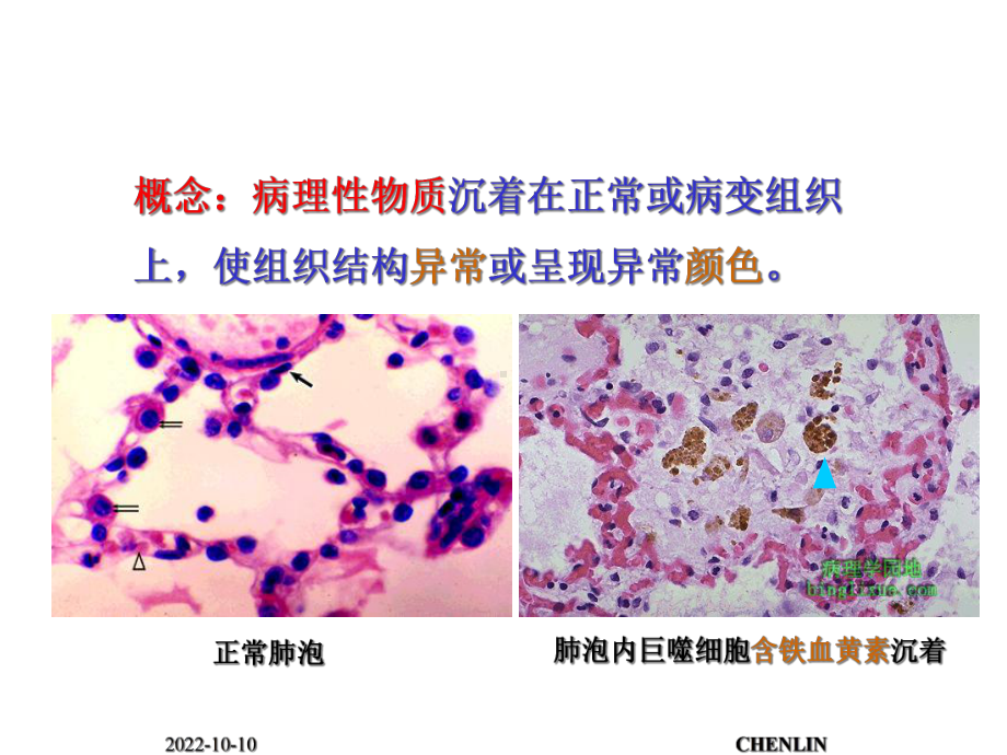 病理性色素沉着和结石CHENLIN课件.ppt_第1页