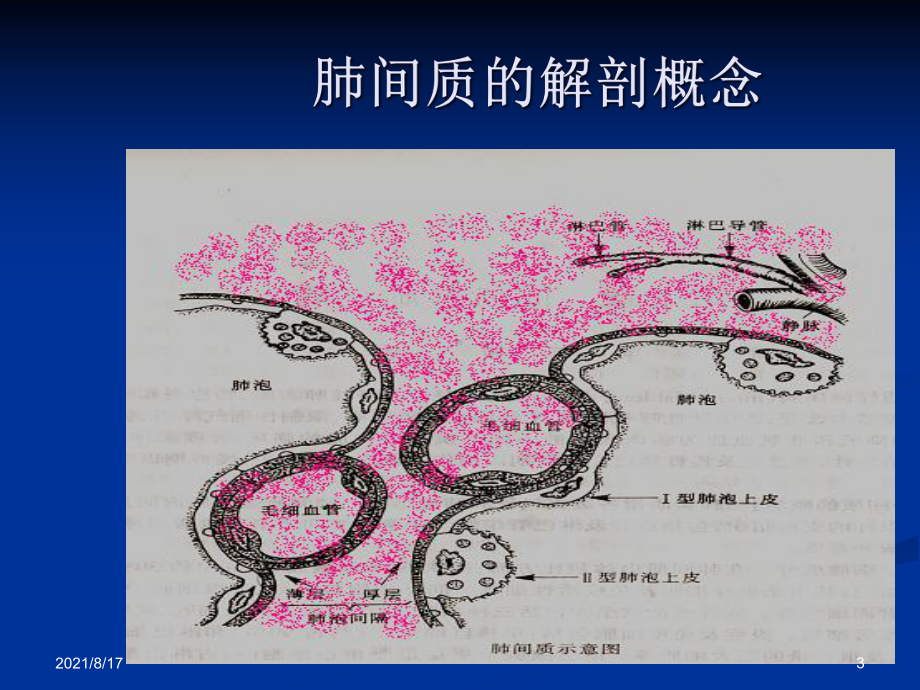 特发性肺纤维化-课件2.ppt_第3页