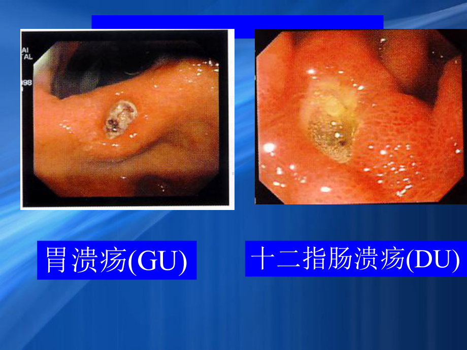 消化性溃疡-科内小讲课培训课件.ppt_第3页