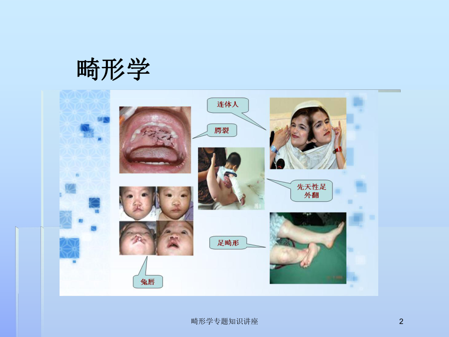 畸形学专题知识讲座培训课件.ppt_第2页