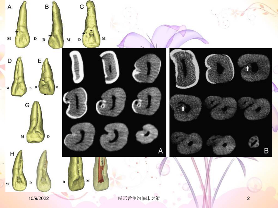 畸形舌侧沟临床对策培训课件.ppt_第2页