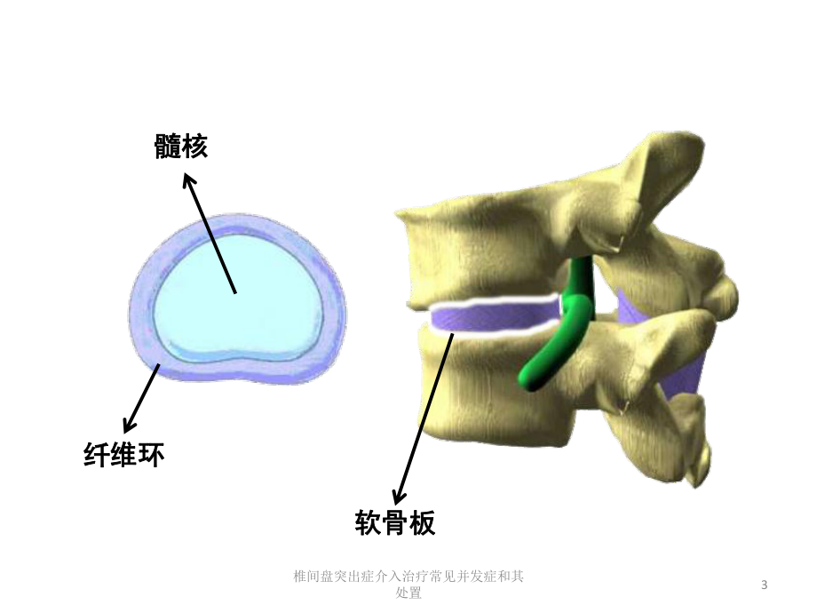 椎间盘突出症介入治疗常见并发症和其处置培训课件.ppt_第3页