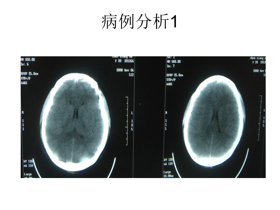 渗透性脱髓鞘综合课件.ppt_第3页