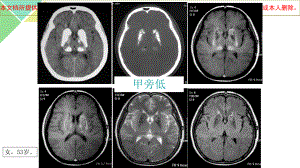 甲状旁腺功能减退症培训课件.ppt