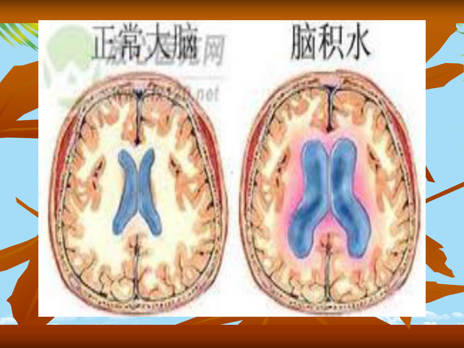 爱爱医资源马大程—脑积水课件.ppt_第2页