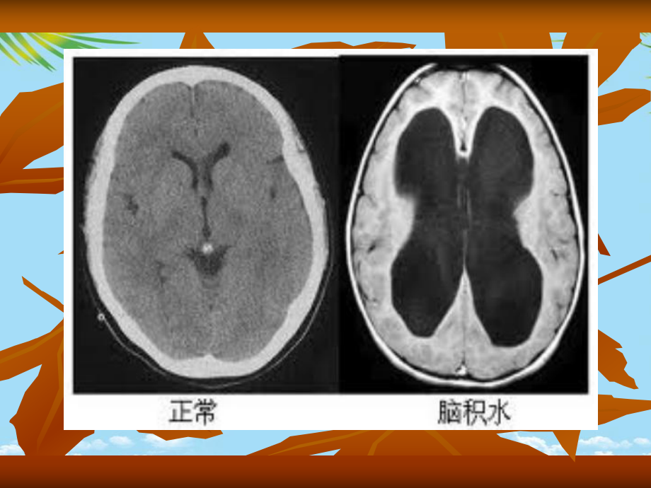 爱爱医资源马大程—脑积水课件.ppt_第3页