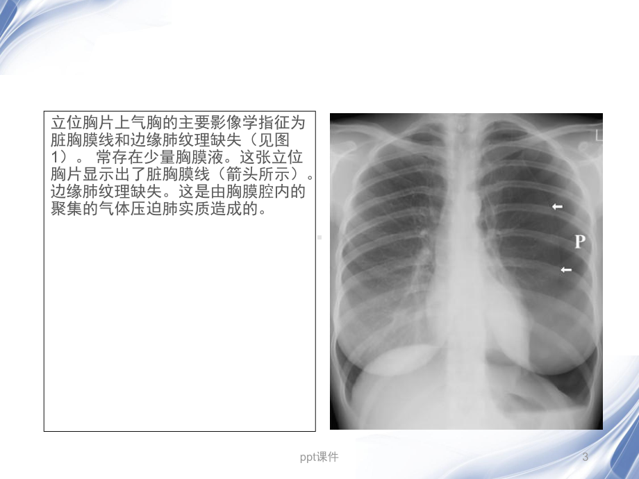 气胸的X线表现-课件.ppt_第3页