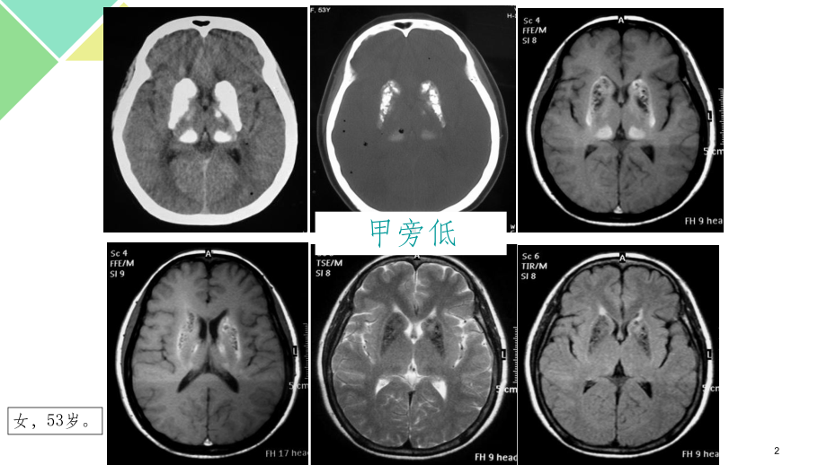 甲状旁腺功能减退症精选课件.ppt_第2页