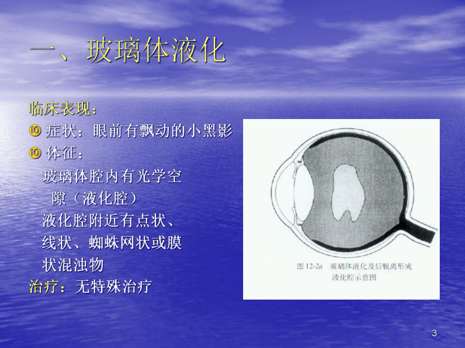 玻璃体疾病课件.ppt_第3页