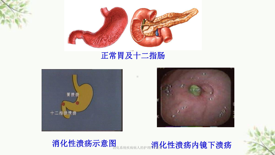 消化系统疾病病人的护理课件-2.ppt_第3页