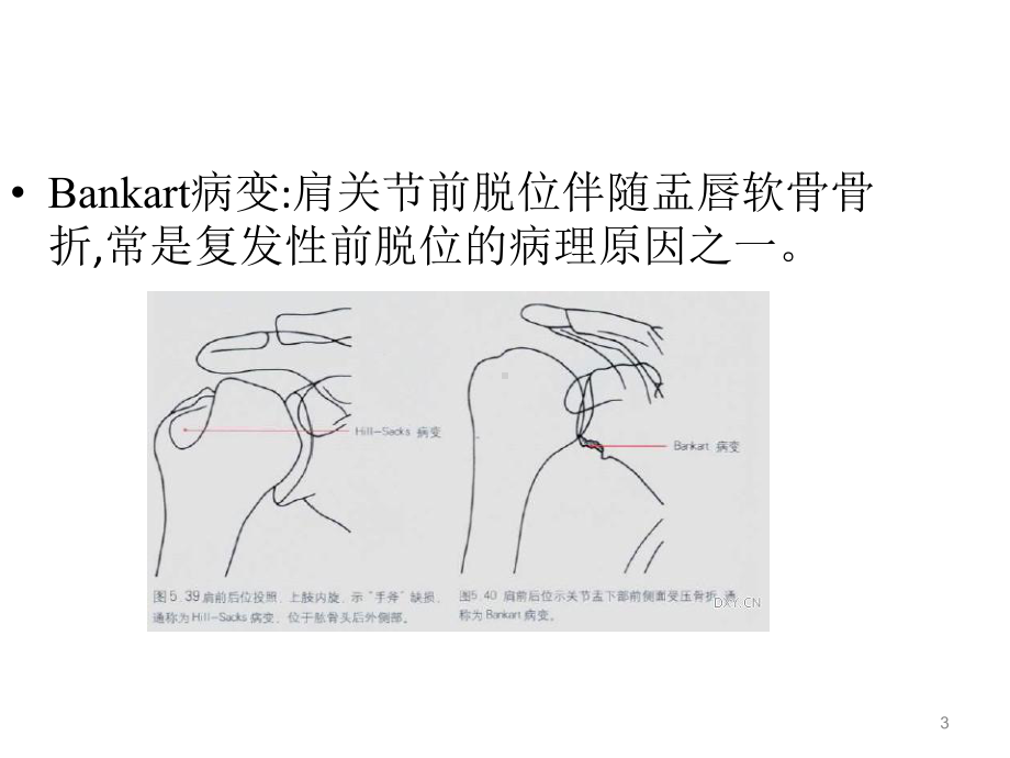 特殊名称骨折课件.ppt_第3页