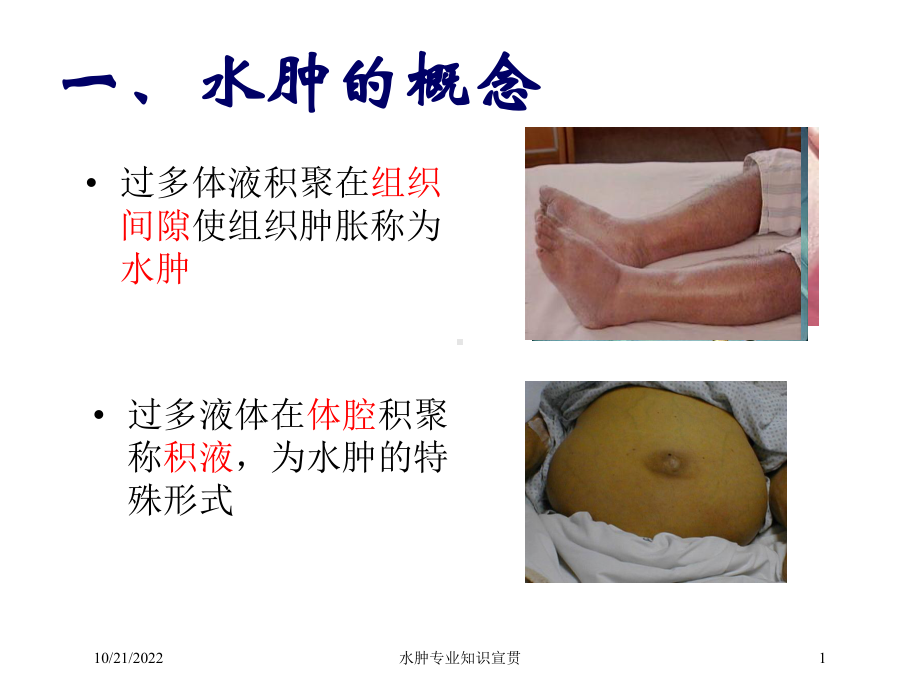 水肿专业知识宣贯培训课件.ppt_第1页