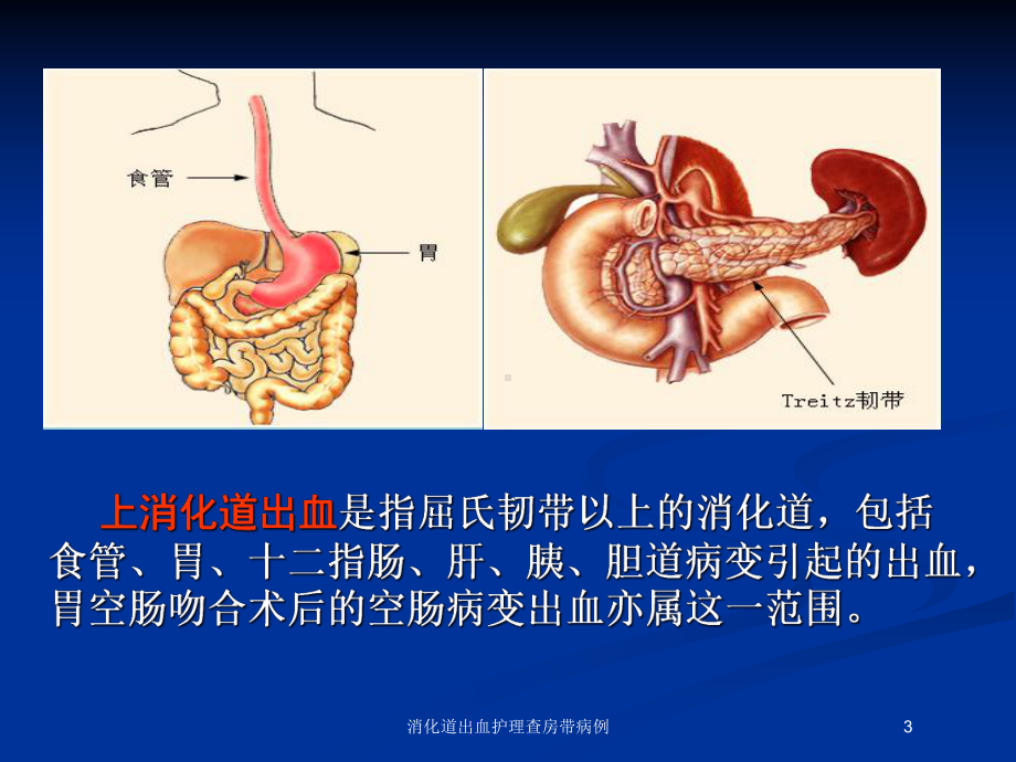 消化道出血护理查房带病例培训课件.ppt_第3页