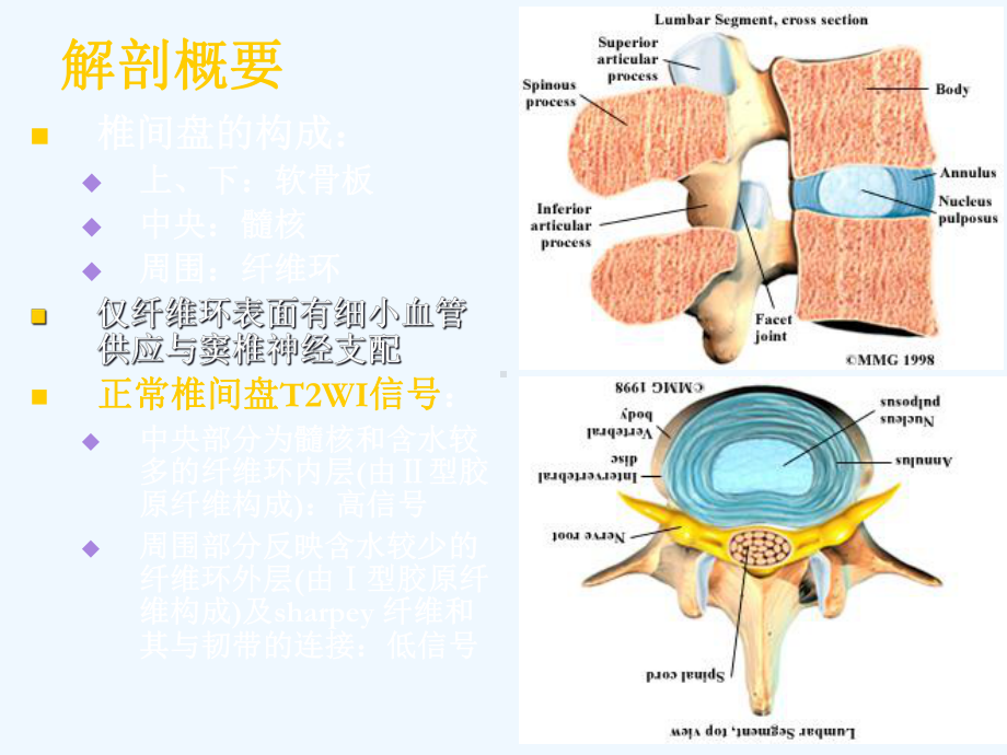 椎间盘突出影像诊断分析课件.ppt_第2页