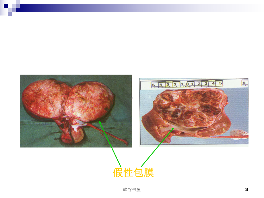 泌尿系肿瘤病人的护理[研究材料]课件.ppt_第3页