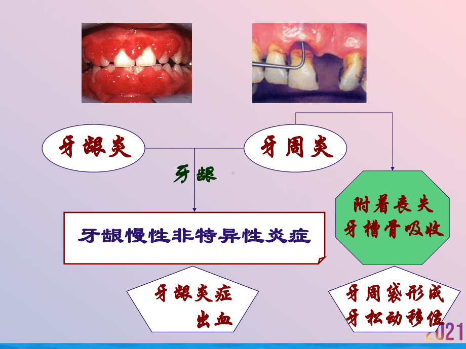 牙周病学牙周病的主要症状和临床病理课件-2.ppt_第2页