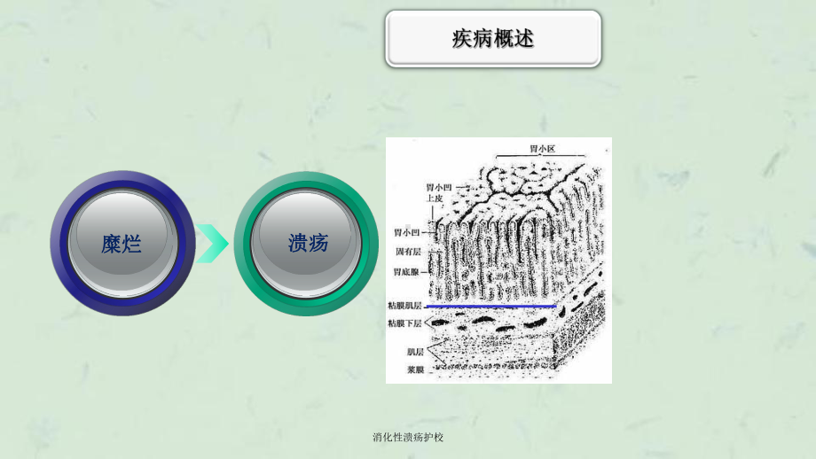 消化性溃疡护校课件.ppt_第3页