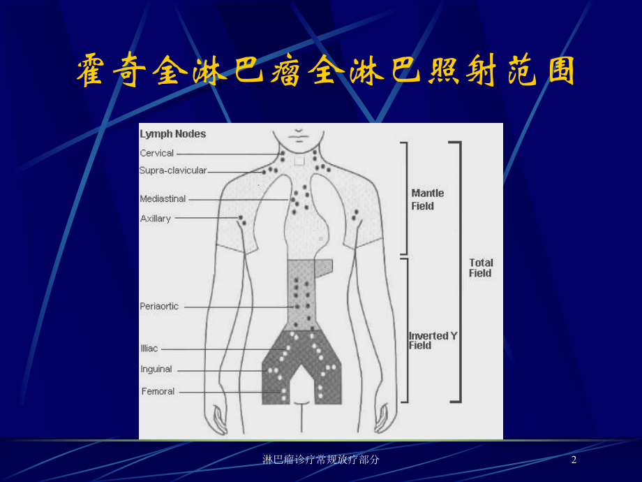 淋巴瘤诊疗常规放疗部分培训课件.ppt_第2页