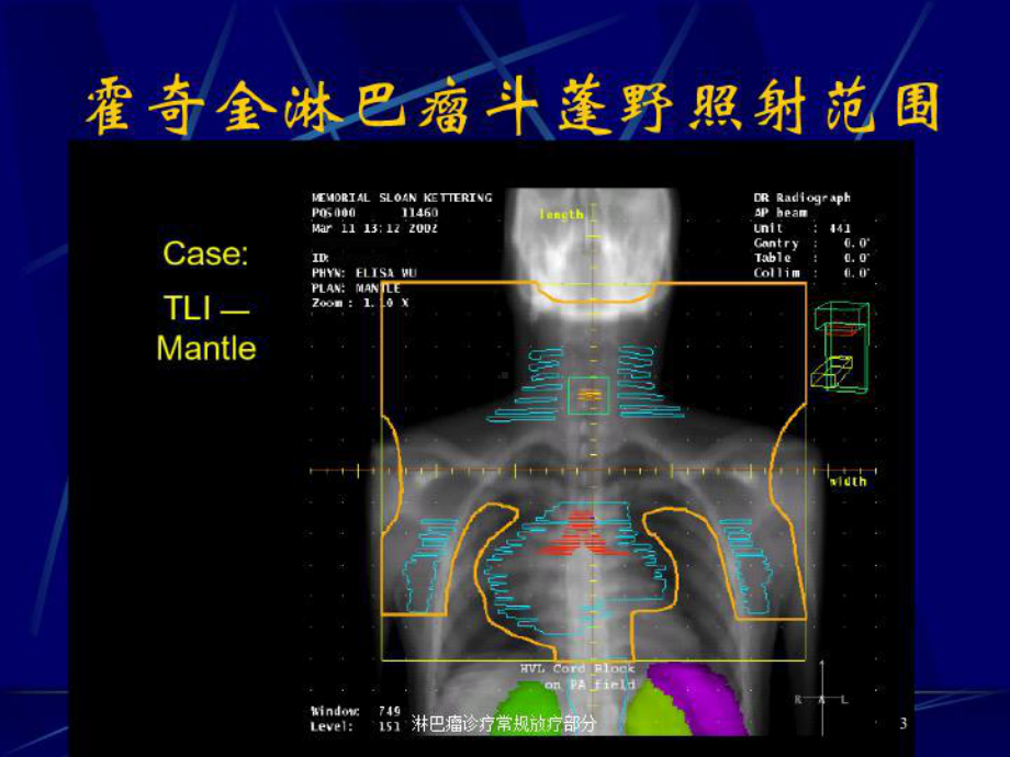 淋巴瘤诊疗常规放疗部分培训课件.ppt_第3页