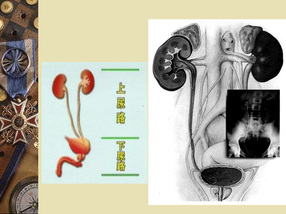 泌尿系结石梗阻课件.ppt_第2页