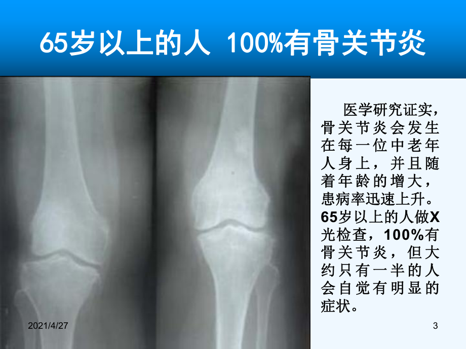 氨糖与骨关节课件.ppt_第3页