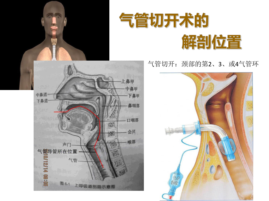 气管切开的护理课件-2.ppt_第3页