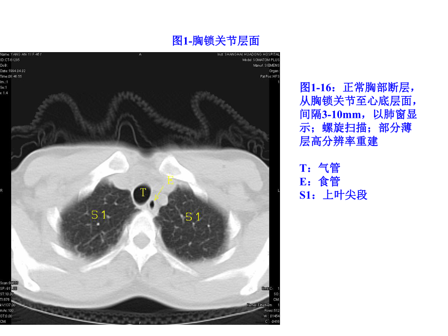 正常胸部CTWXM课件.ppt_第2页