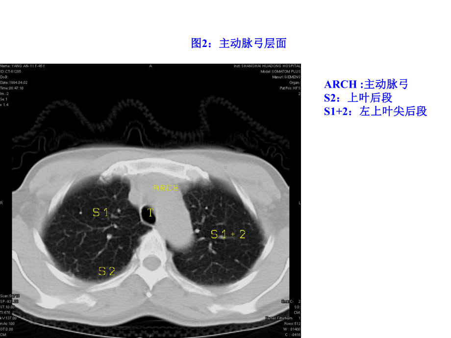 正常胸部CTWXM课件.ppt_第3页