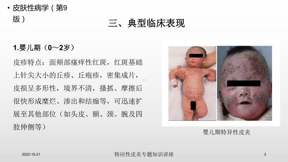 特应性皮炎专题知识讲座培训课件.ppt_第3页