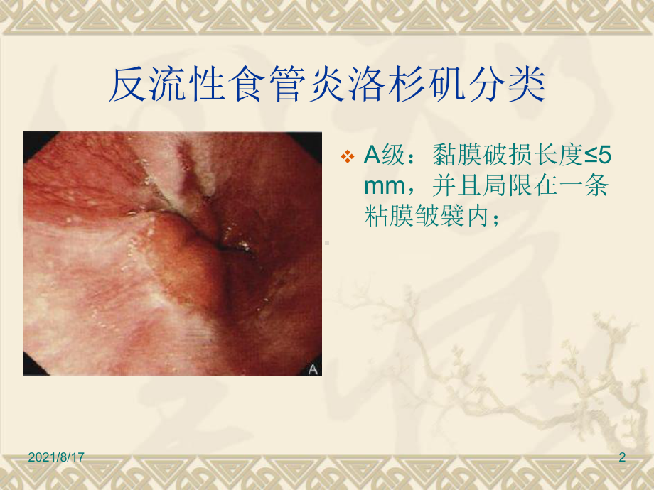 消化道疾患内镜分级诊断课件.ppt_第2页