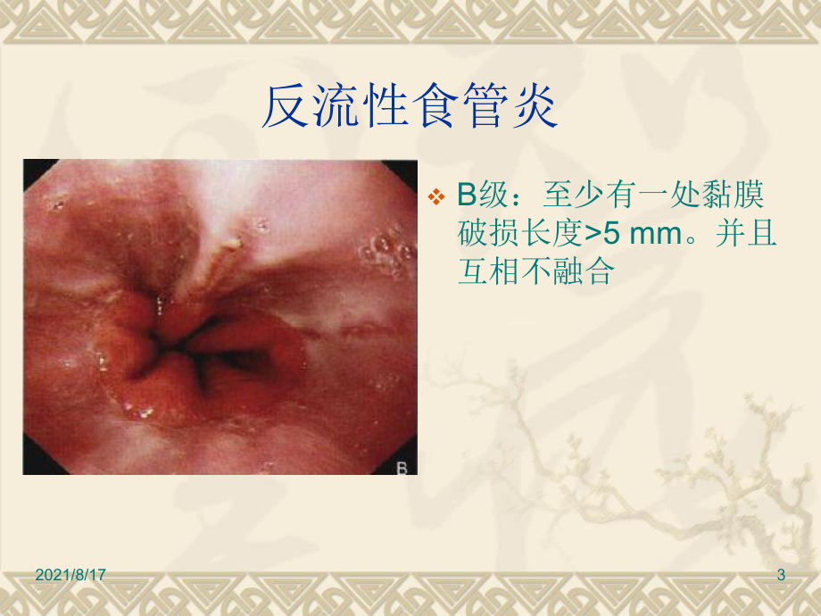 消化道疾患内镜分级诊断课件.ppt_第3页