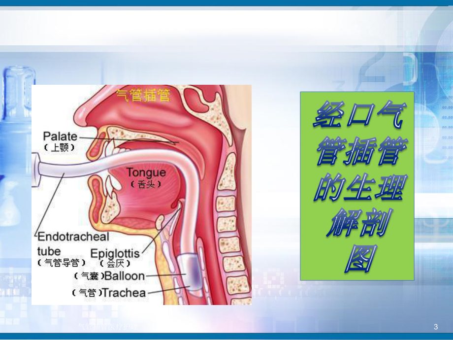 气管插管医疗护理培训课件.ppt_第3页