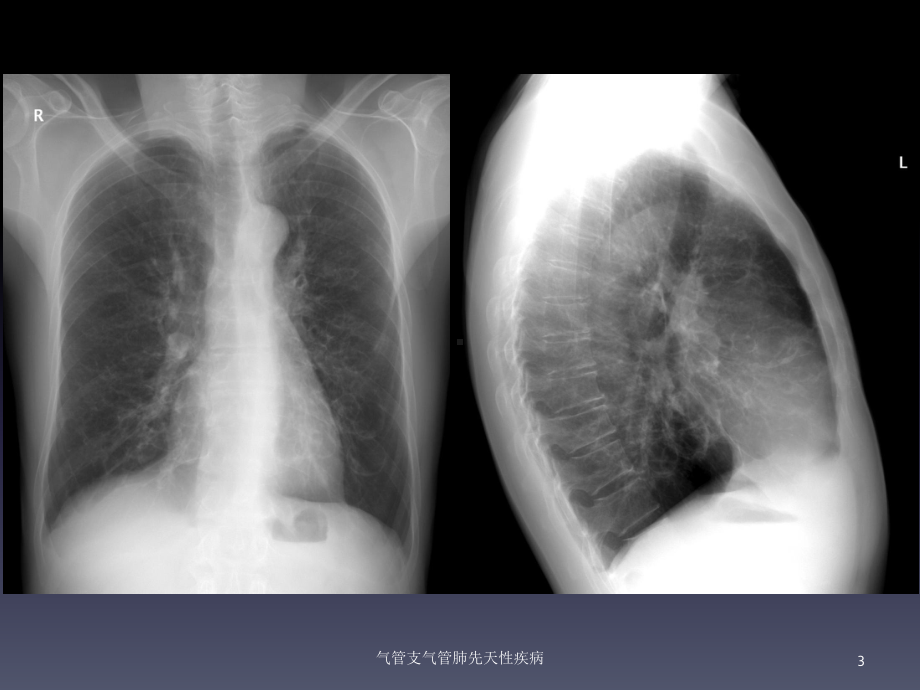 气管支气管肺先天性疾病培训课件.ppt_第3页