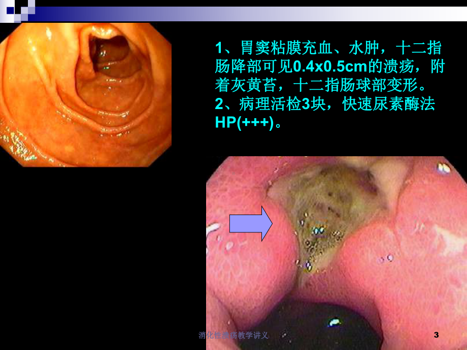 消化性溃疡教学讲义培训课件.ppt_第3页