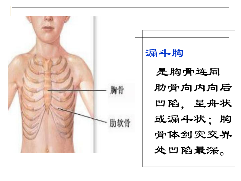 漏斗胸讲解专题知识讲座培训课件.ppt_第3页