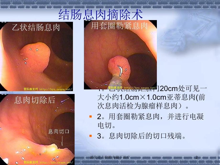 消化道占位的内镜下治疗培训课件.ppt_第2页