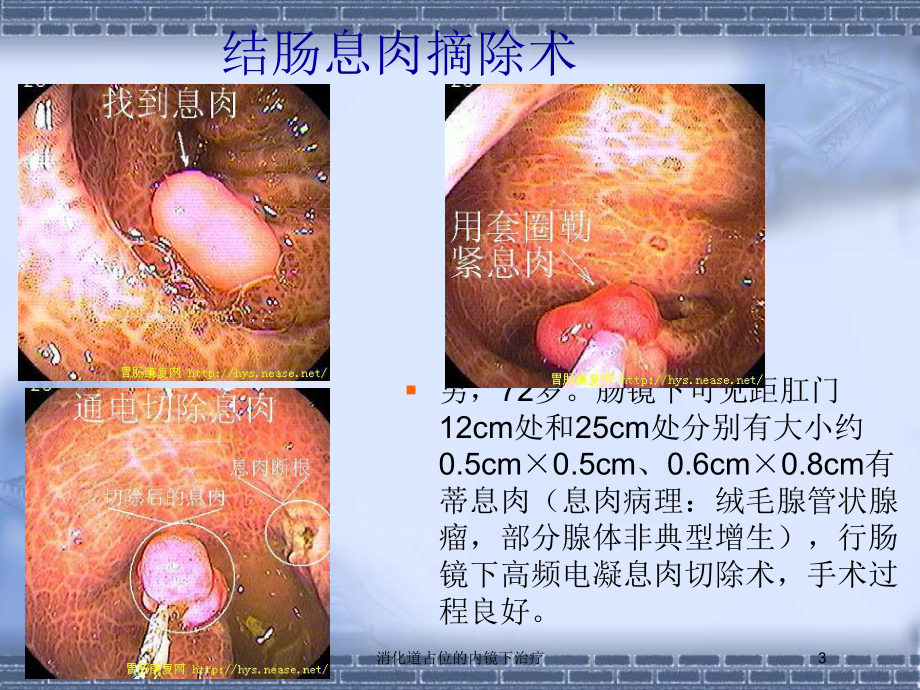 消化道占位的内镜下治疗培训课件.ppt_第3页