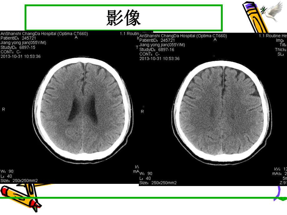 病例讨论脱髓鞘疾病课件.ppt_第3页