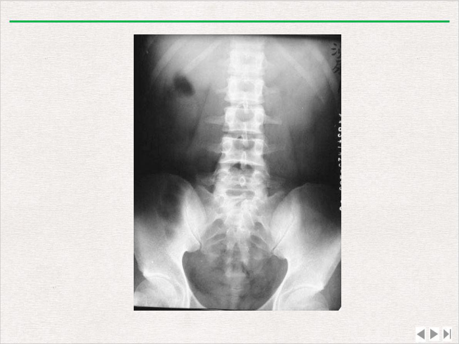 泌尿系统病变X线诊断版课件.pptx_第3页