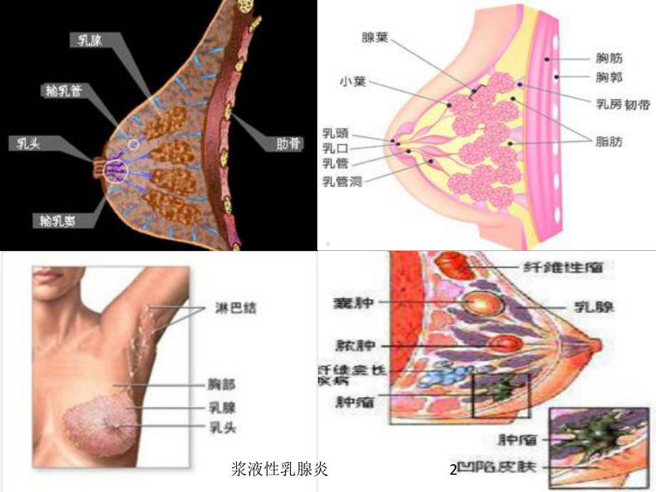 浆液性乳腺炎培训课件.ppt_第2页