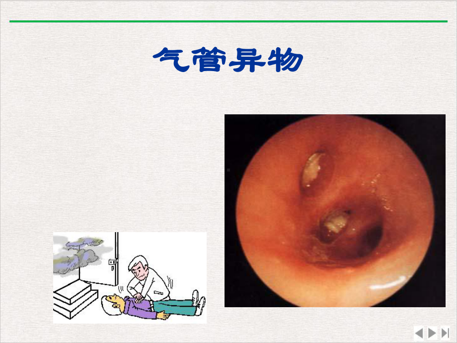 气管支气管及食管异物课件.pptx_第2页