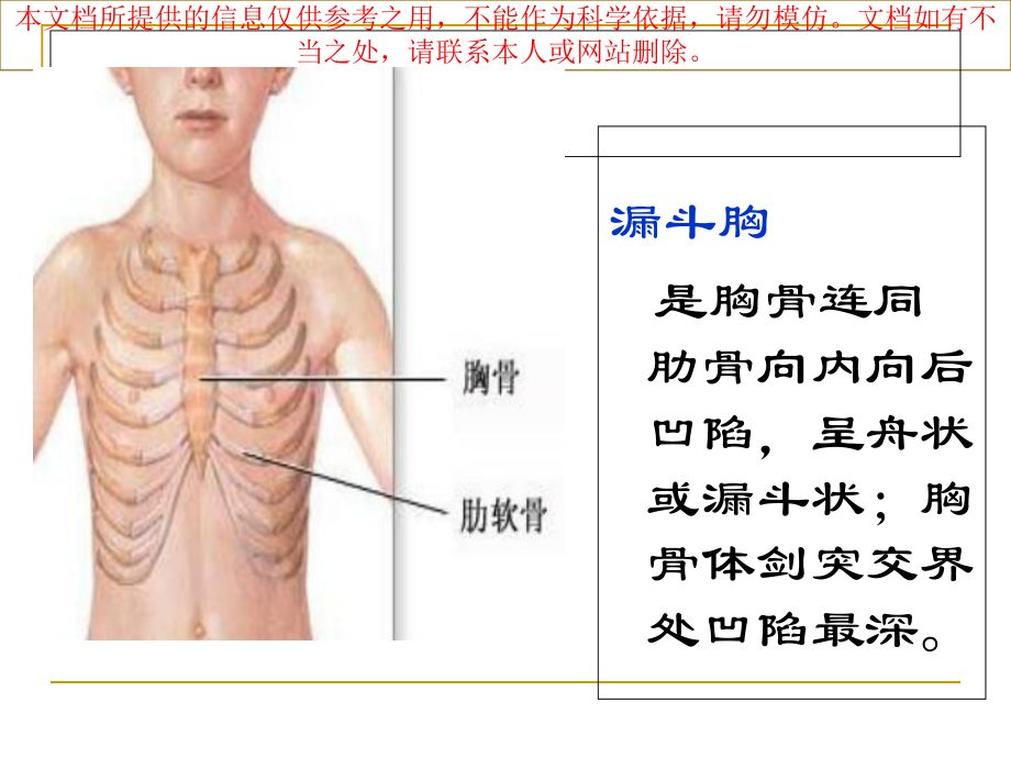 漏斗胸讲解专题知识宣讲培训课件.ppt_第2页