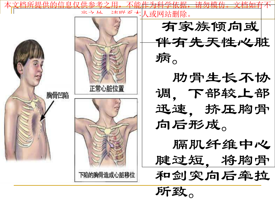 漏斗胸讲解专题知识宣讲培训课件.ppt_第3页