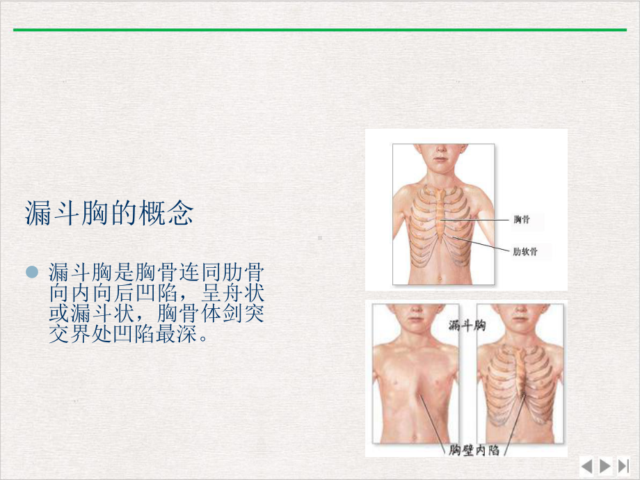 漏斗胸病人围手术期护理课件完整版.pptx_第1页