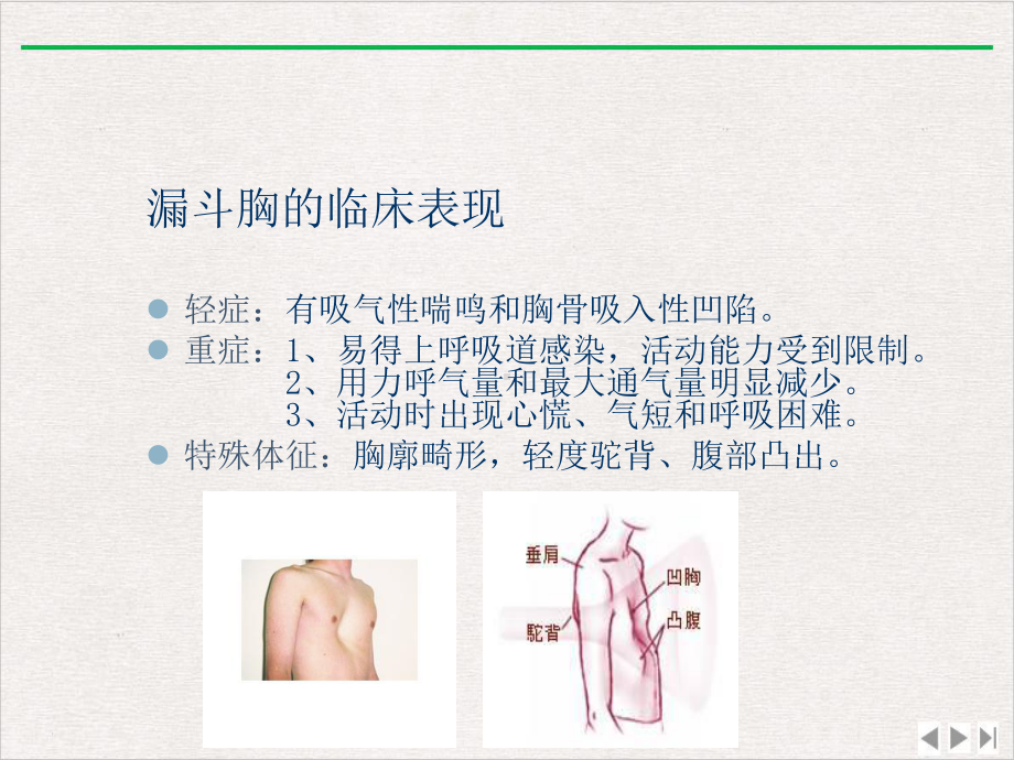 漏斗胸病人围手术期护理课件完整版.pptx_第3页