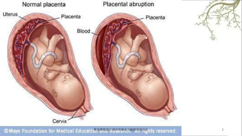 熊员焕胎盘早剥并发凝血功能障碍的诊治课件.ppt_第2页