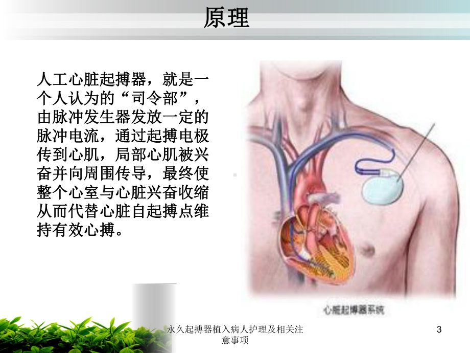 永久起搏器植入病人护理及相关注意事项培训课件.ppt_第3页